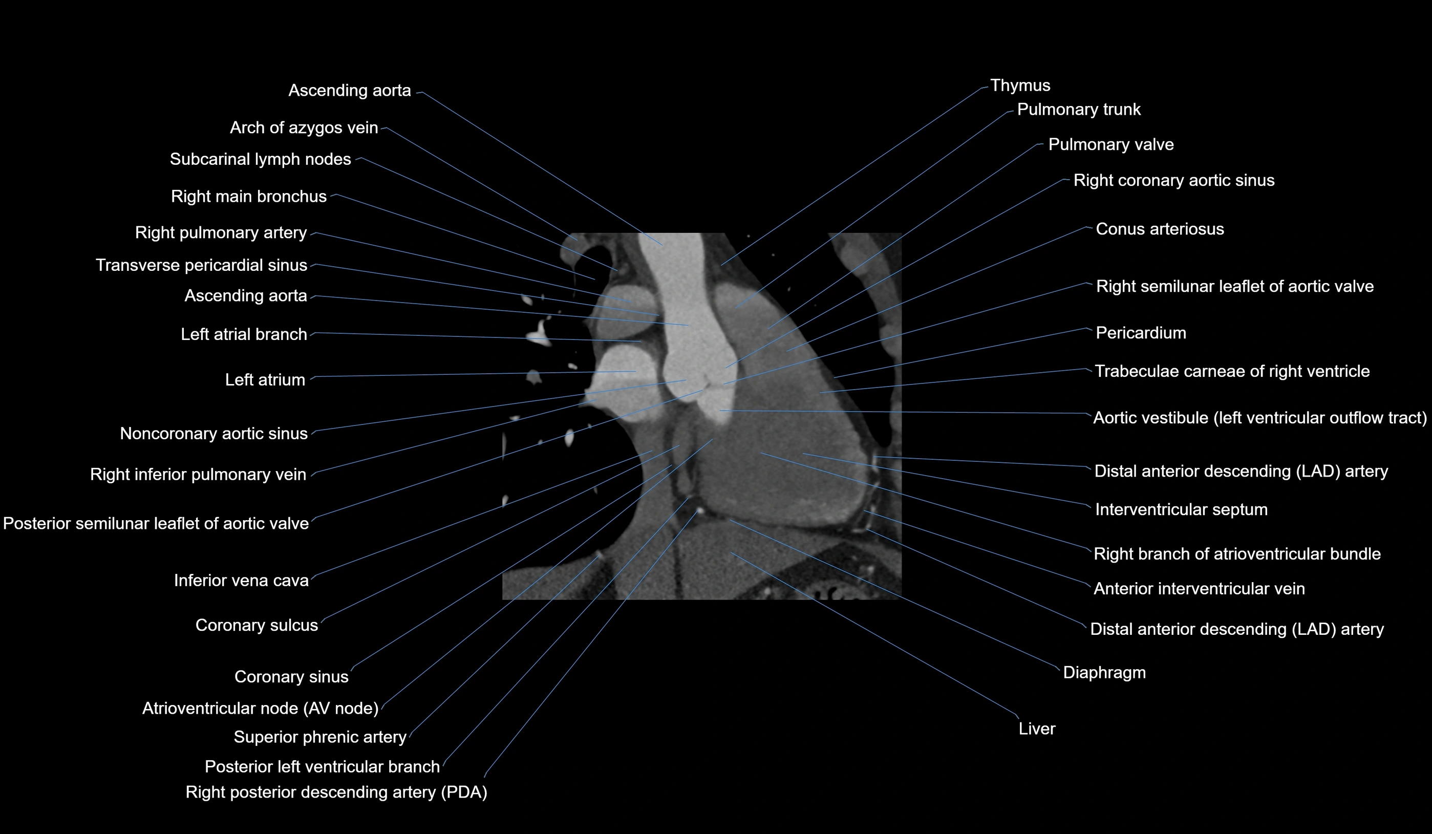 CT heart (coronary angiogram) 2 chamber view cross sectional anatomy labelled radiology image-00023.webp